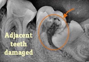 Symptoms of wisdom tooth infection