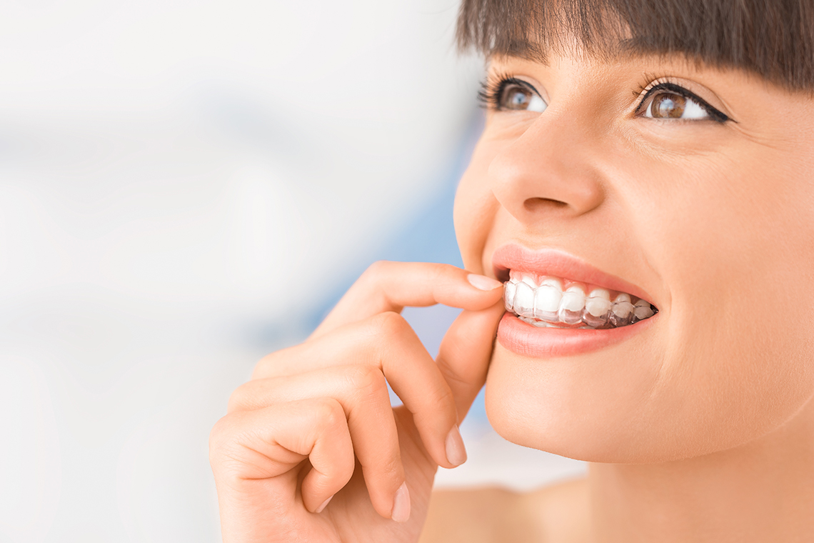 Clear aligner by cosmetic dentists in Brisbane