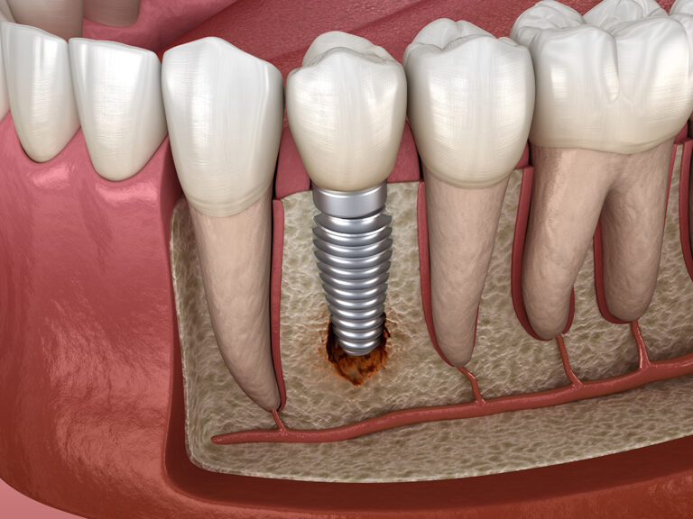 Tooth replacement solutions Brisbane