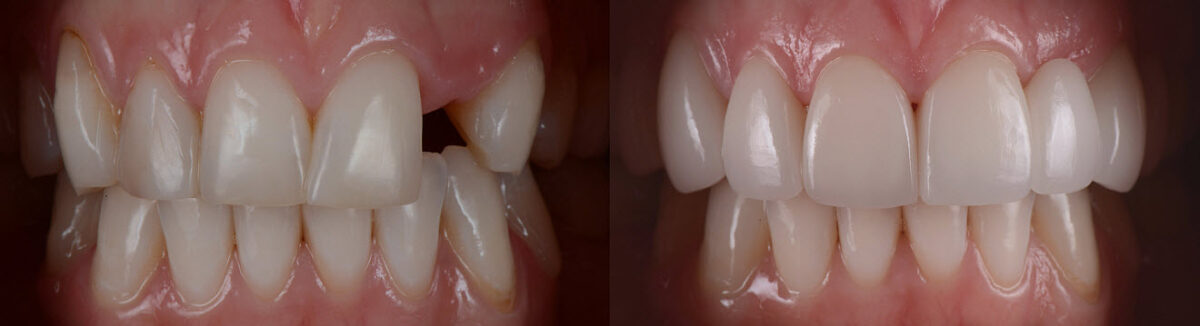 Dental Bridges Before After