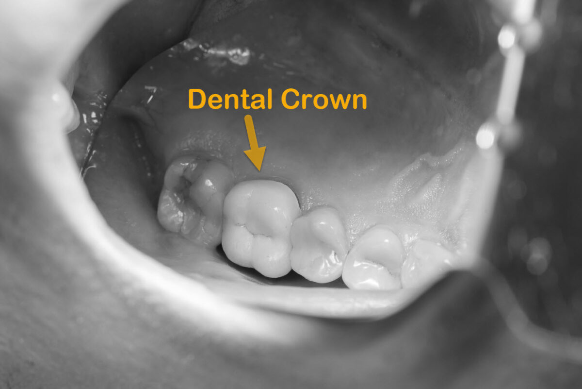 Dental Tooth Crowns Brisbane