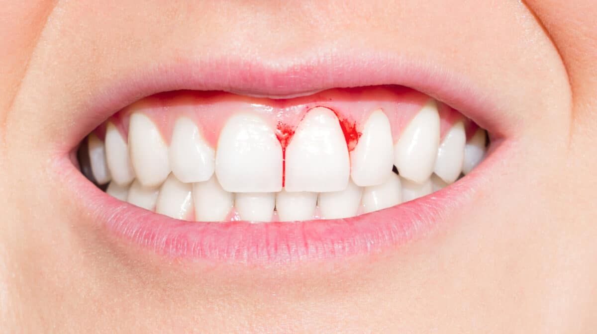 Broken or knocked out tooth dentist near eight mile plains