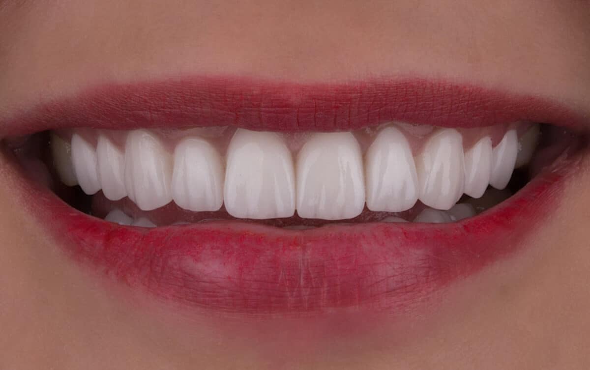 Porcelain Veneers Before and After photos by Cosmetic Dentist Dr Raghed Bashour