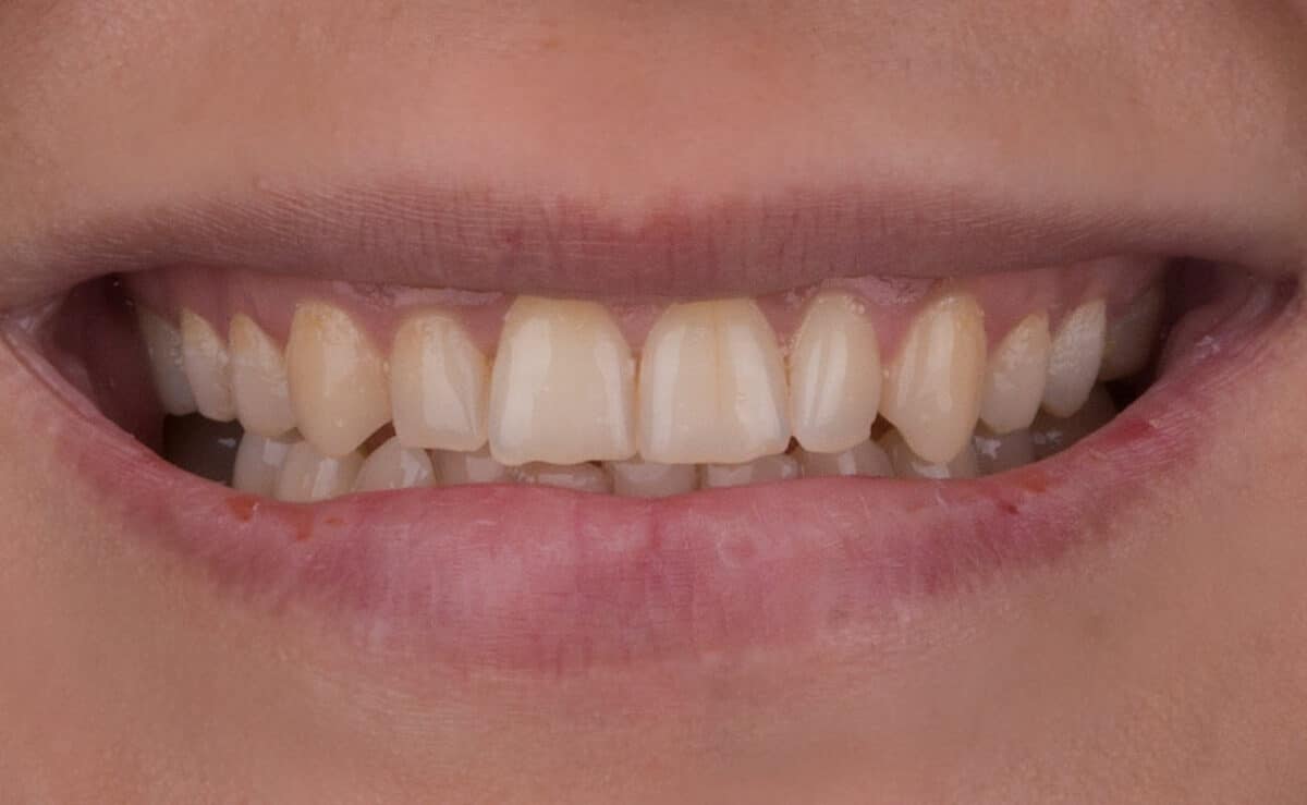 Dental Veneers Before and after results by Dr Raghed Bashour Brisbane Cosmetic Dentist