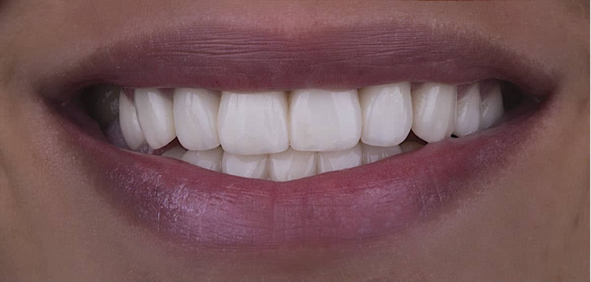 porcelain dental veneers that can dramatically improve your appearance