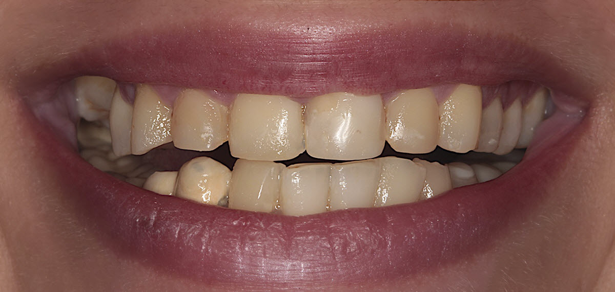 Dental Veneer Before and After - Dr. Raghed Bashour, Brisbane Cosmetic Dentist