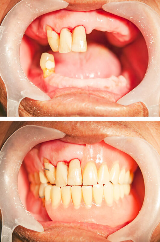 Dentures Brisbane Before and After