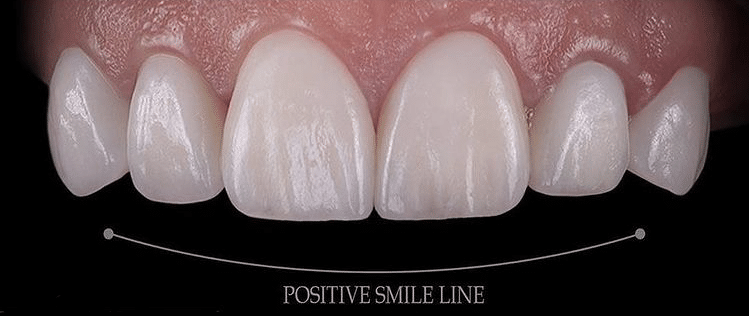 See the dental veneer before and after results by Dr Raghed