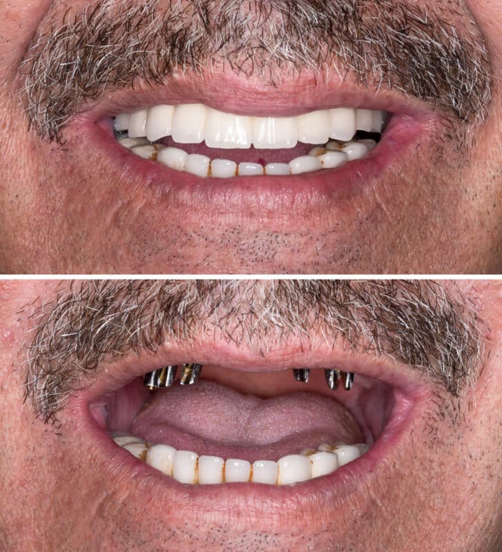 Recovery after full mouth rehabilitation
