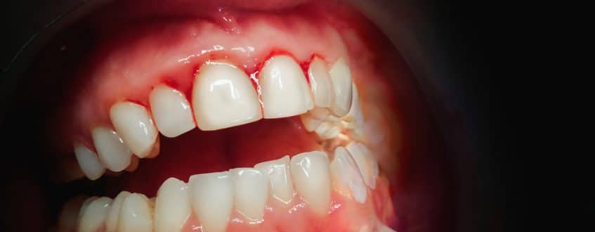 Front Teeth Cavity: The Ultimate Guide to Prevention and Treatment