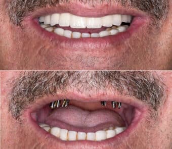 Sedative Dentistry for Extensive Mouth Repair