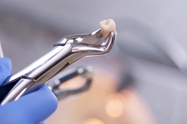 Impacted Wisdom Tooth Removal in Brisbane