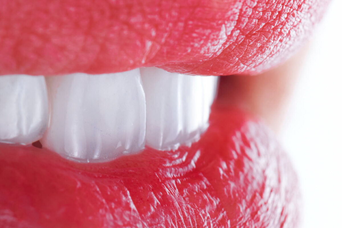 Cosmetic dentist's teeth whitening Brisbane