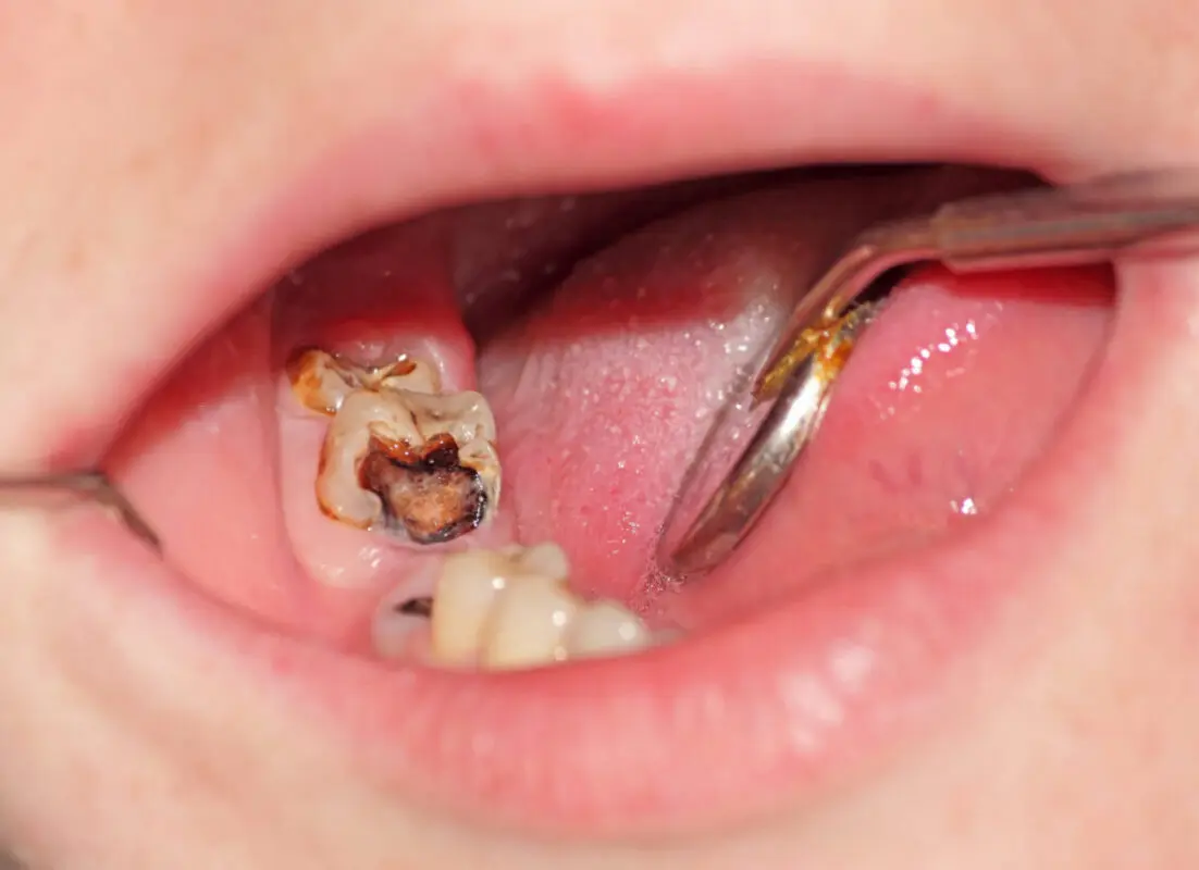 Fixing severely decayed tooth