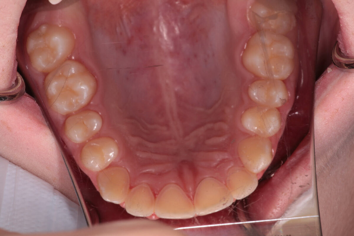 erosion of the tooth surface
