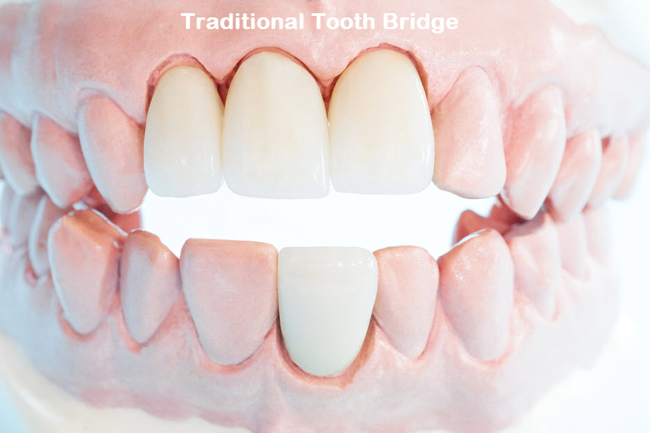 A traditional tooth bridge is one of the fastest ways to replace a missing tooth