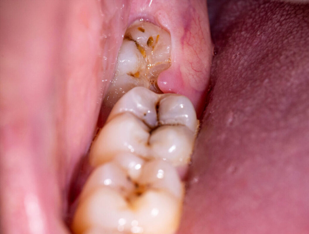 impacted wisdom tooth gum sore