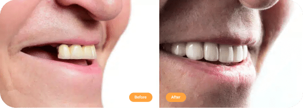 Before and after dental implants in Brisbane.