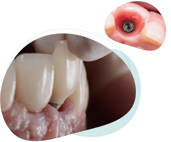 Benefits of the screw in dental implant Brisbane.