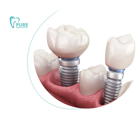 Dental implants Brisbane Queensland.