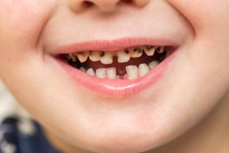 tooth decay in children