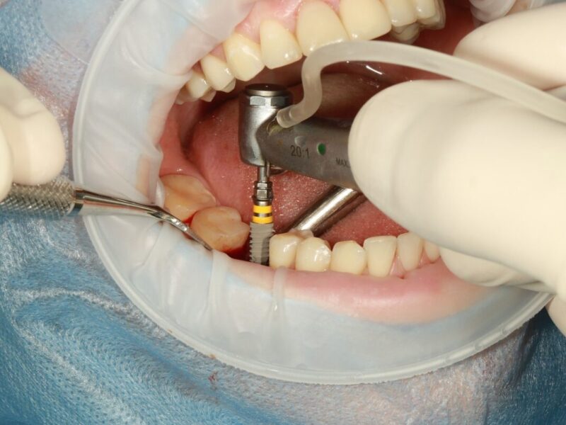 dental implants lifespan