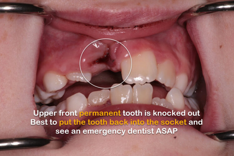 Central incisor tooth knocked out