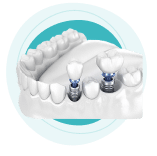 2 Dental implants Brisbane.
