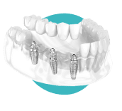 Multi screw dental implant Brisbane.
