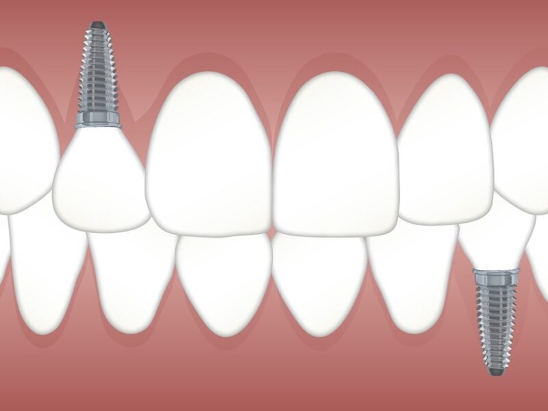 dental implants lifespan