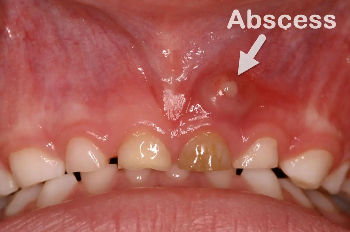Dolor de muelas con pus debajo de las encías (absceso dental)