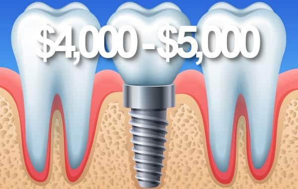 Price of dental implants in Brisbane.