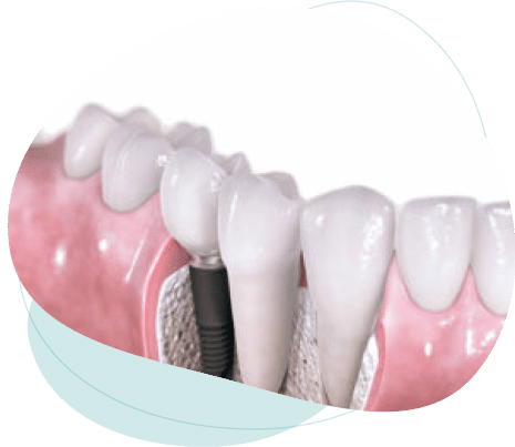 Tooth implant service Brisbane south.