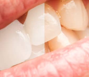 Tooth discoloration