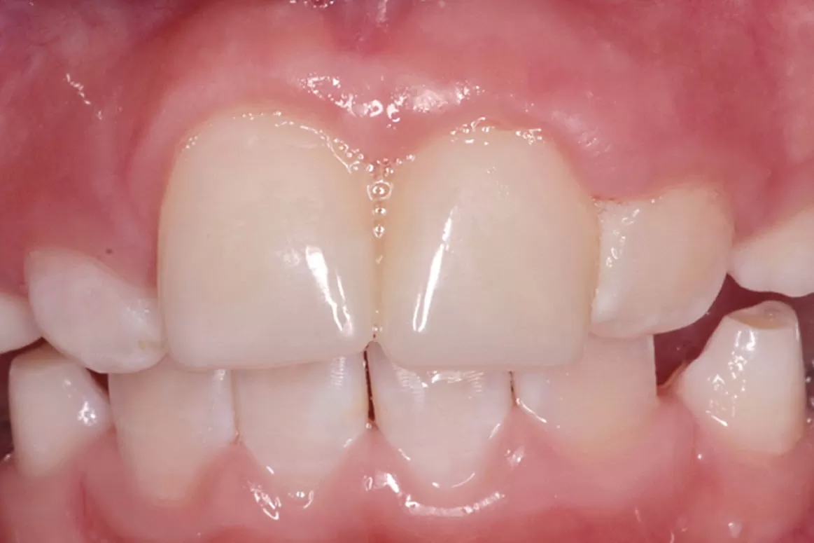 Broken tooth repaired by composite crown
